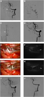 Arteriovenous fistulas in the craniocervical junction region: With vs. without spinal arterial feeders